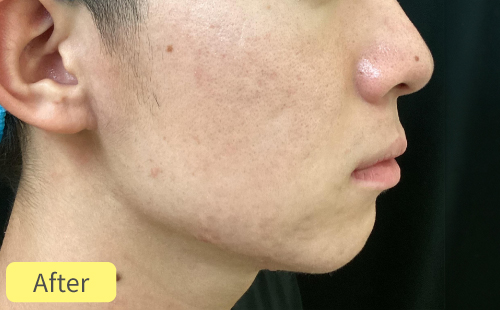 ニキビ治療症例After