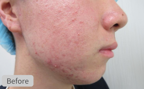 ニキビ治療症例Before