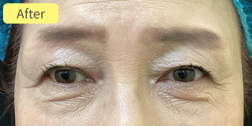 眉下切開症例After