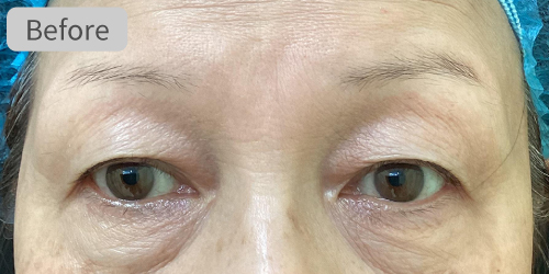 眉下切開症例Before