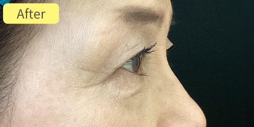 眉下切開症例After