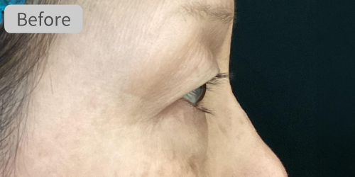 眉下切開症例Before