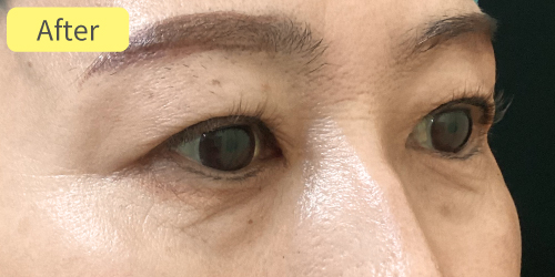 眉下切開症例After