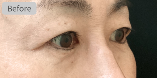 眉下切開症例Before