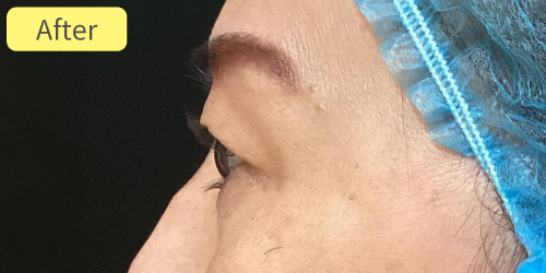 眉下切開症例After