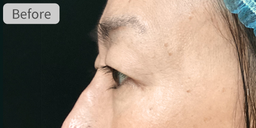 眉下切開症例Before