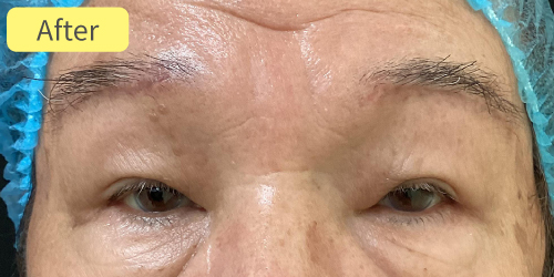 眉下切開症例After