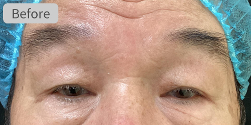 眉下切開症例Before