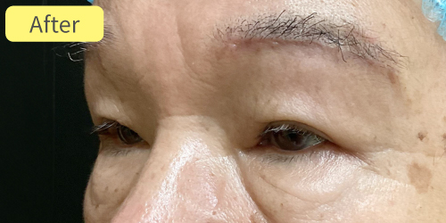 眉下切開症例After