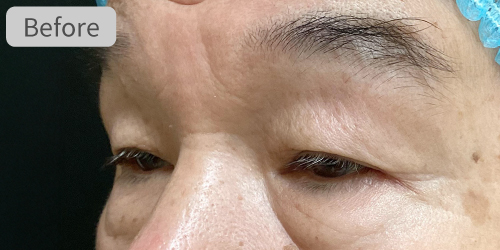 眉下切開症例Before