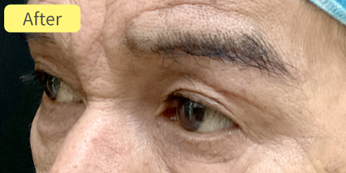 眉下切開症例After