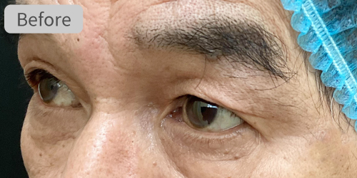 眉下切開症例Before