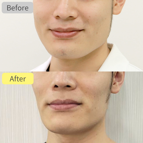 エラボトックス症例