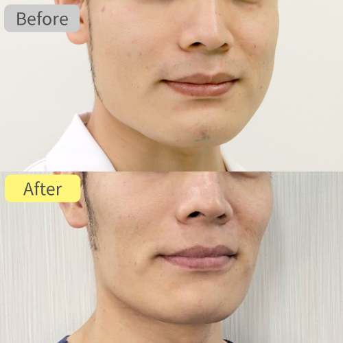 エラボトックス症例