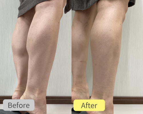 ふくらはぎボトックス症例