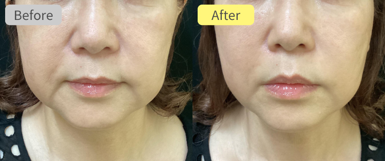 デンシティ症例写真