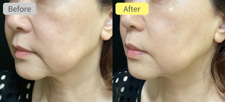 デンシティ症例写真