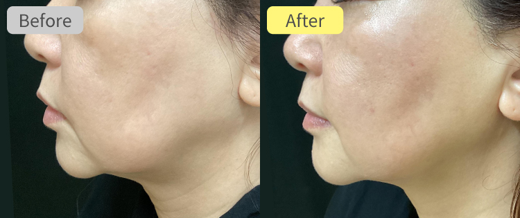 デンシティ アルファチップ症例