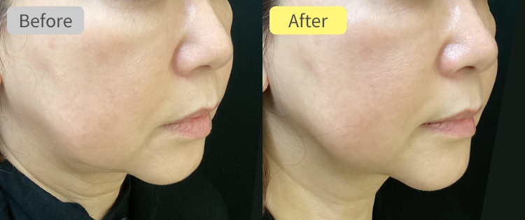 デンシティ アルファチップ症例