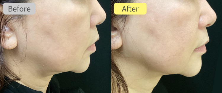 デンシティ アルファチップ症例