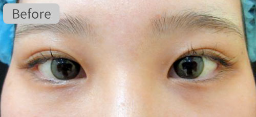 二重切開法+目頭切開法症例Before