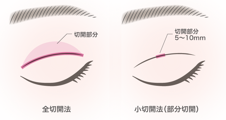 全切開と部分切開の違い
