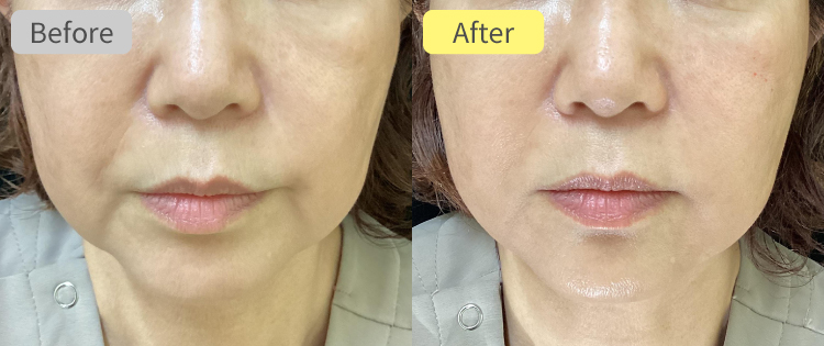 ヒアルロン酸注射 マリオネットライン症例