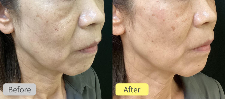 ヒアルロン酸リフトアップ症例