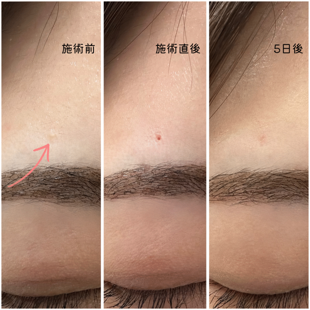 コメド（白ニキビ）症例