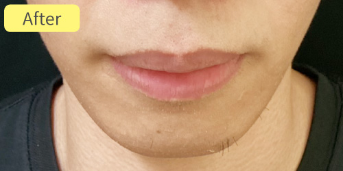 口唇縮小症例After