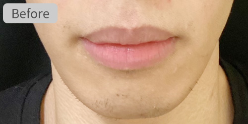 口唇縮小症例Before