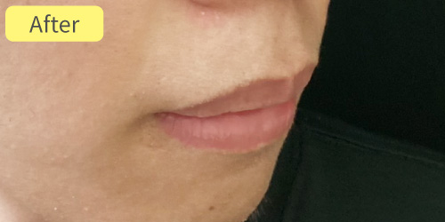 口唇縮小症例After