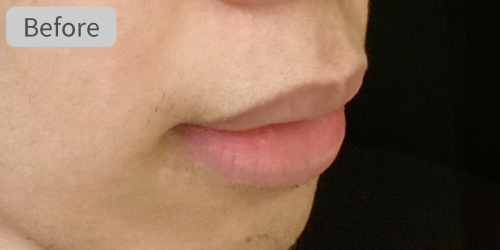 口唇縮小症例Before