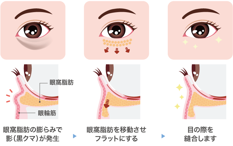 下眼瞼切開(ハムラ法)の手術方法