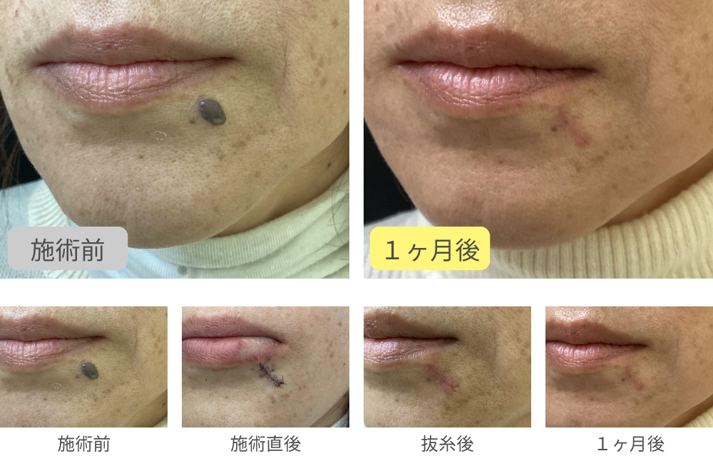 ほくろ切開法症例