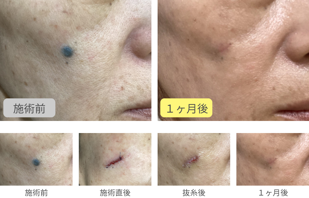 ほくろ切開法症例