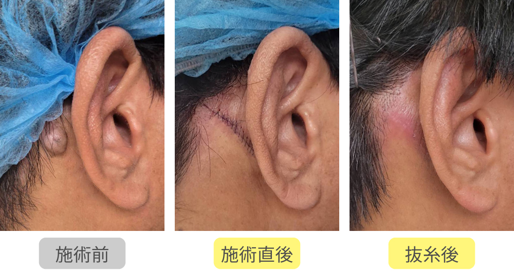 ほくろ切開法症例