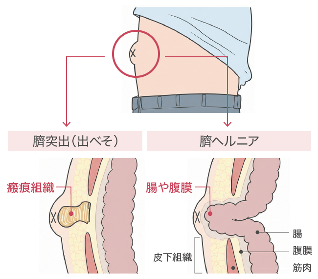 でべその種類