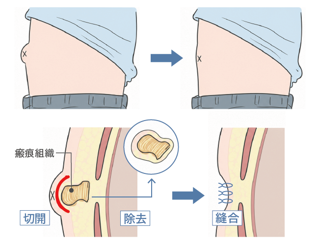 でべそ手術