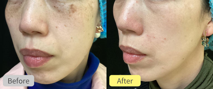 ピコジェネシス＋ライムライト＋ほくろエルビウムヤグレーザー＋シミピコスポット症例