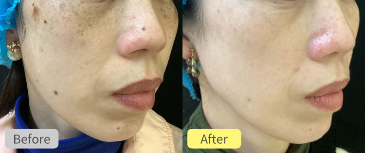 ピコジェネシス＋ライムライト＋ほくろエルビウムヤグレーザー＋シミピコスポット症例