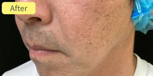 シミピコスポット症例After