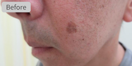 シミピコスポット症例Before