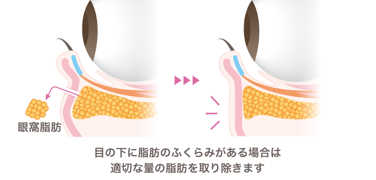 目の下のたるみ取り
