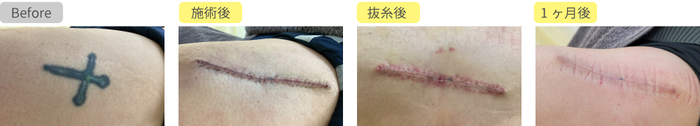 タトゥー除去切除法症例