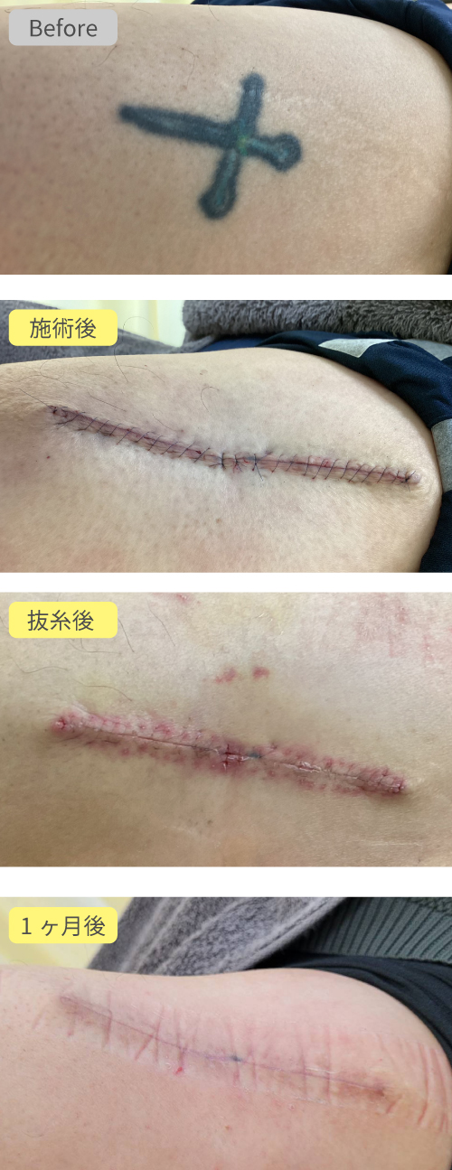 タトゥー除去切除法症例