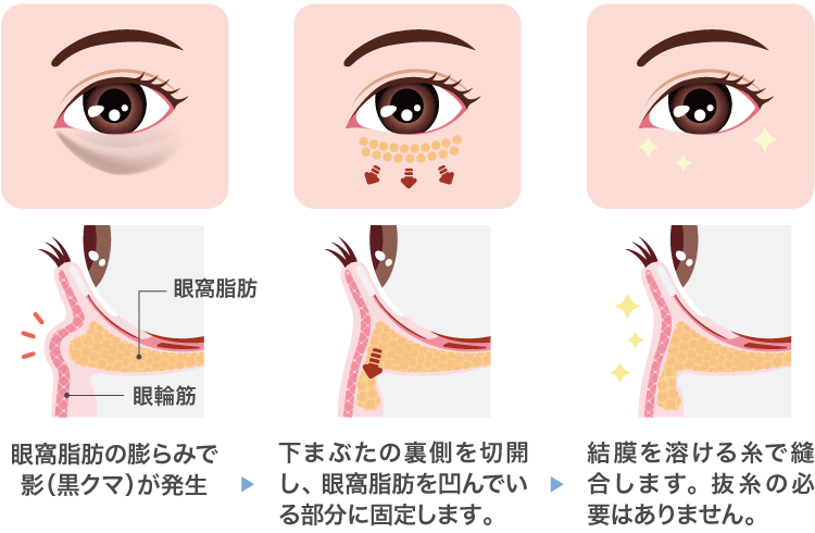 裏ハムラの手術方法
