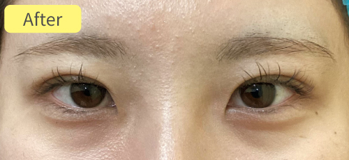 埋没法症例After