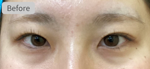 埋没法症例Before